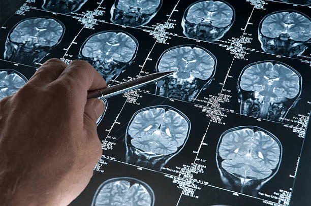 the-connection-between-neurodegenerative-diseases-and-template-misfolding-proteins